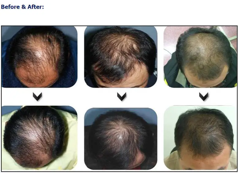 lllt hair loss therapy before and after does laser treatment work for hair loss